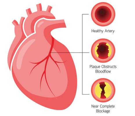 Máu nhiễm mỡ tăng nguy cơ mắc bệnh tim mạch 